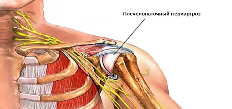 Плече-лопаточный периартроз